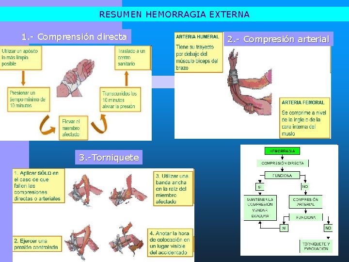 RESUMEN HEMORRAGIA EXTERNA 1. - Comprensión directa 3. -Torniquete 2. - Compresión arterial 