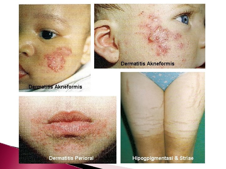 Dermatitis Akneformis Dermatitis Perioral Hipogpigmentasi & Striae 