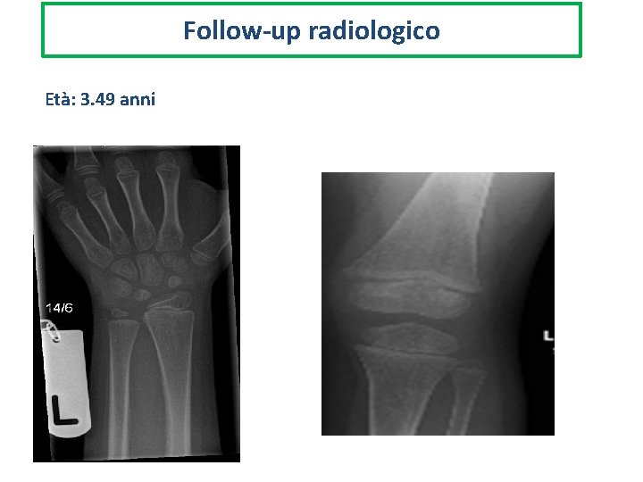 Follow-up radiologico Età: 3. 49 anni 