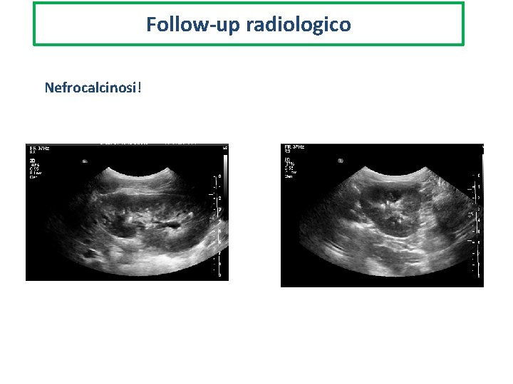 Follow-up radiologico Nefrocalcinosi! 