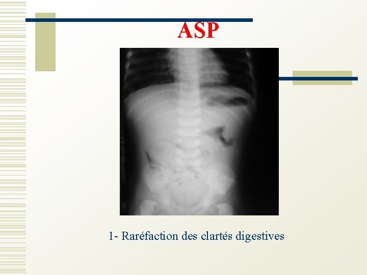 ASP 1 - Raréfaction des clartés digestives 