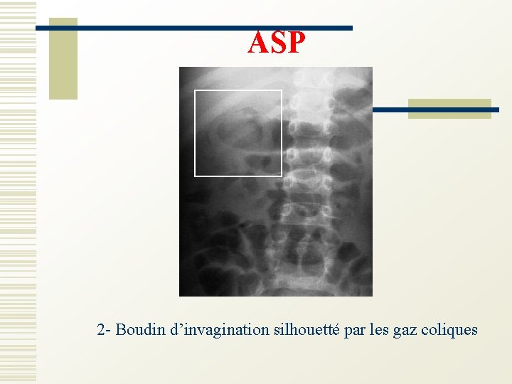 ASP 2 - Boudin d’invagination silhouetté par les gaz coliques 