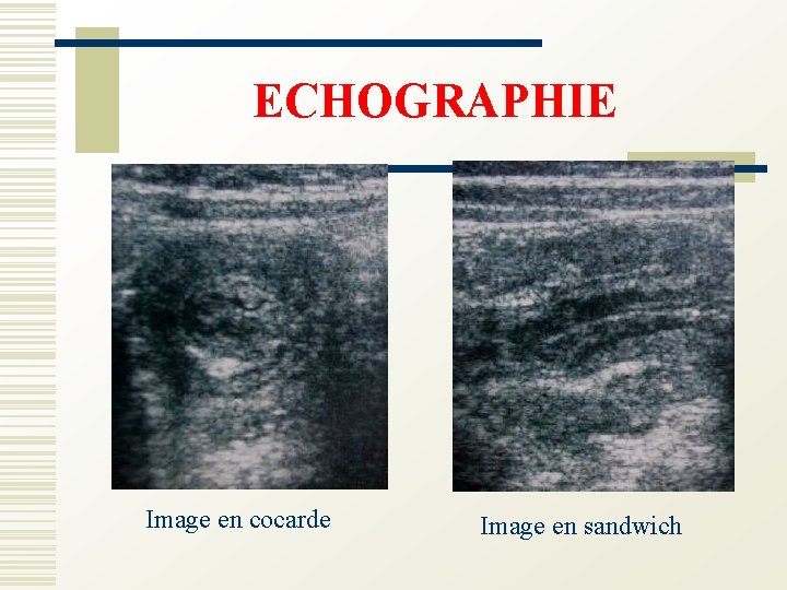 ECHOGRAPHIE Image en cocarde Image en sandwich 