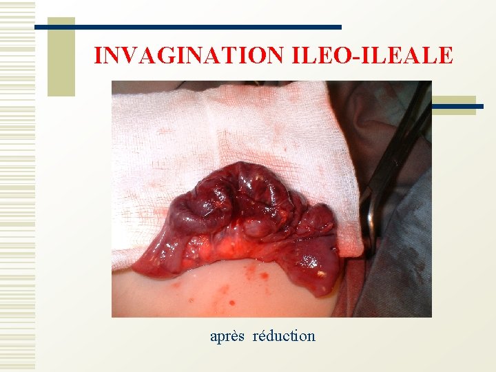 INVAGINATION ILEO-ILEALE après réduction 