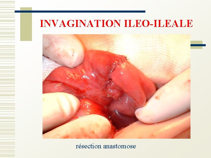 INVAGINATION ILEO-ILEALE résection anastomose 