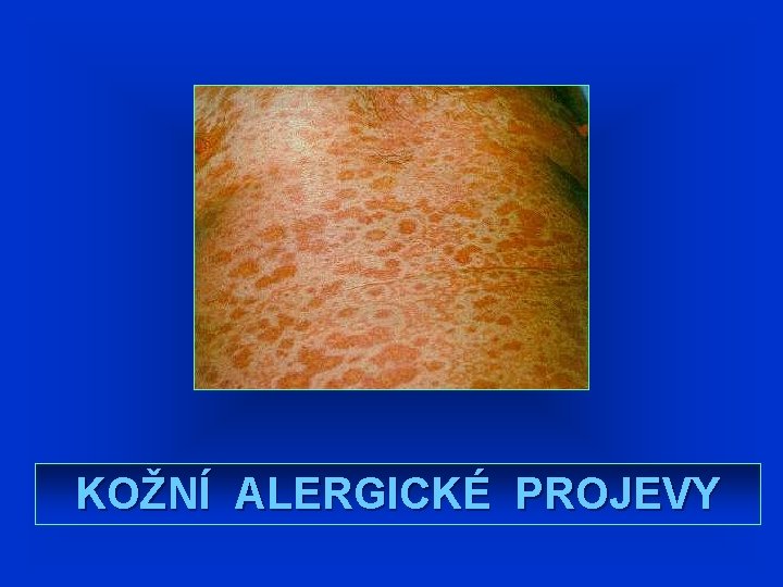 KOŽNÍ ALERGICKÉ PROJEVY KOŽNÍ ALERGICKÉ PROJEVY
