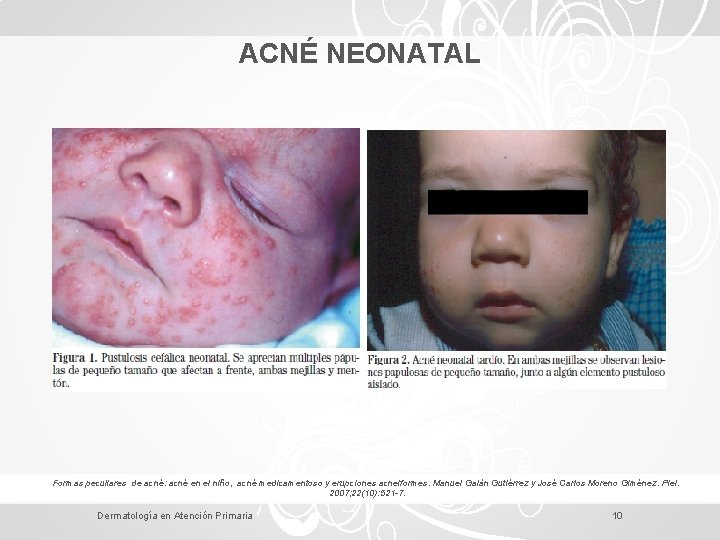 ACNÉ NEONATAL Formas peculiares de acné: acné en el niño, acné medicamentoso y erupciones