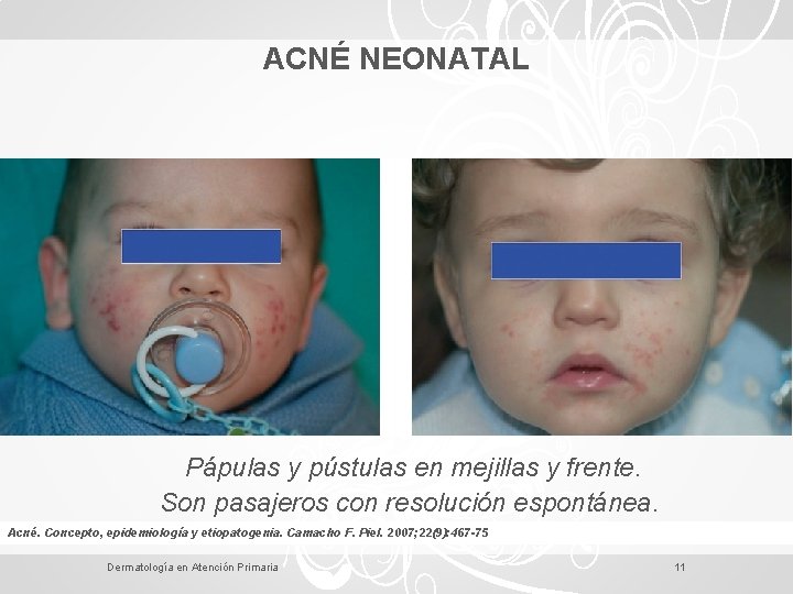 ACNÉ NEONATAL Pápulas y pústulas en mejillas y frente. Son pasajeros con resolución espontánea.