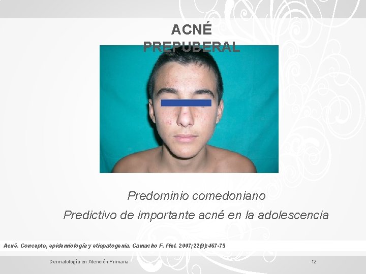 ACNÉ PREPUBERAL Predominio comedoniano Predictivo de importante acné en la adolescencia Acné. Concepto, epidemiología