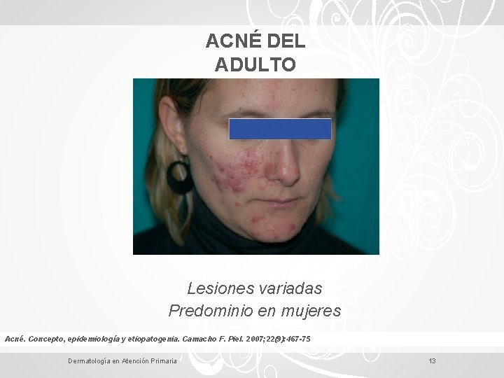 ACNÉ DEL ADULTO Lesiones variadas Predominio en mujeres Acné. Concepto, epidemiología y etiopatogenia. Camacho