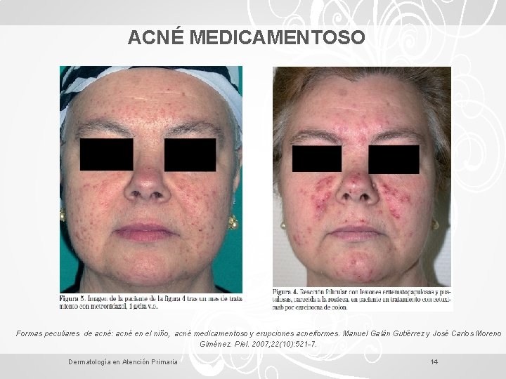 ACNÉ MEDICAMENTOSO Formas peculiares de acné: acné en el niño, acné medicamentoso y erupciones