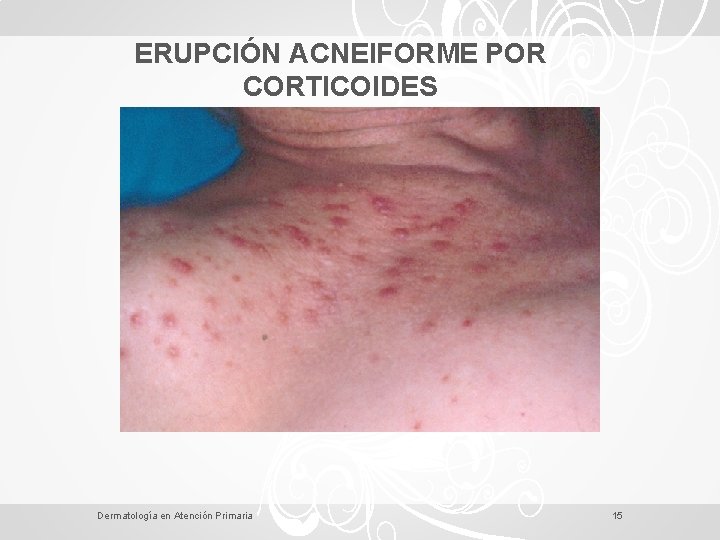 ERUPCIÓN ACNEIFORME POR CORTICOIDES Dermatología en Atención Primaria 15 