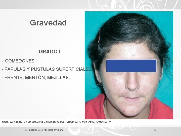 Gravedad GRADO I - COMEDONES - PÁPULAS Y PÚSTULAS SUPERFICIALES - FRENTE, MENTÓN, MEJILLAS.