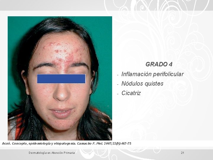 GRADO 4 - Inflamación perifolicular - Nódulos quistes - Cicatriz Acné. Concepto, epidemiología y