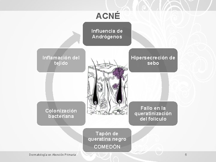 ACNÉ Influencia de Andrógenos Inflamación del tejido Hipersecreción de sebo Colonización bacteriana Fallo en