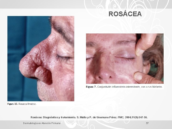 ROSÁCEA Rosácea: Diagnóstico y tratamiento. S. Mallo y P. de Unamuno Pérez. FMC. 2004;