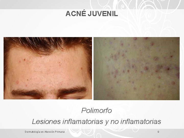 ACNÉ JUVENIL Polimorfo Lesiones inflamatorias y no inflamatorias Dermatología en Atención Primaria 9 