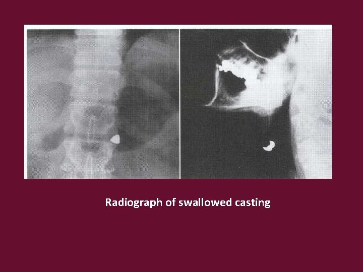 Radiograph of swallowed casting 