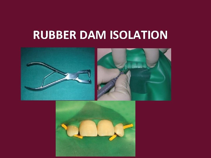 RUBBER DAM ISOLATION 