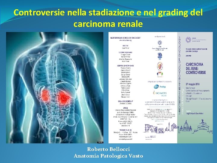 Controversie nella stadiazione e nel grading del carcinoma renale Roberto Bellocci Anatomia Patologica Vasto