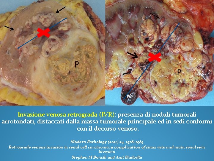 Invasione venosa retrograda (IVR): presenza di noduli tumorali arrotondati, distaccati dalla massa tumorale principale