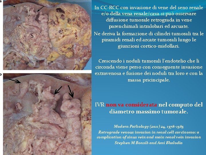 In CC-RCC con invasione di vene del seno renale e/o della vena renale/cava si