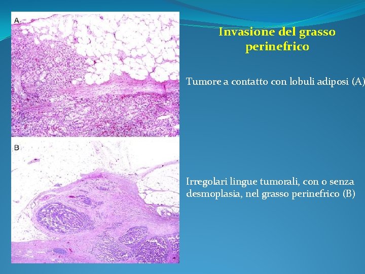 Invasione del grasso perinefrico Tumore a contatto con lobuli adiposi (A) Irregolari lingue tumorali,