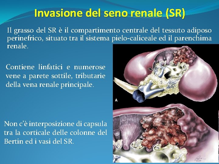 Invasione del seno renale (SR) Il grasso del SR è il compartimento centrale del