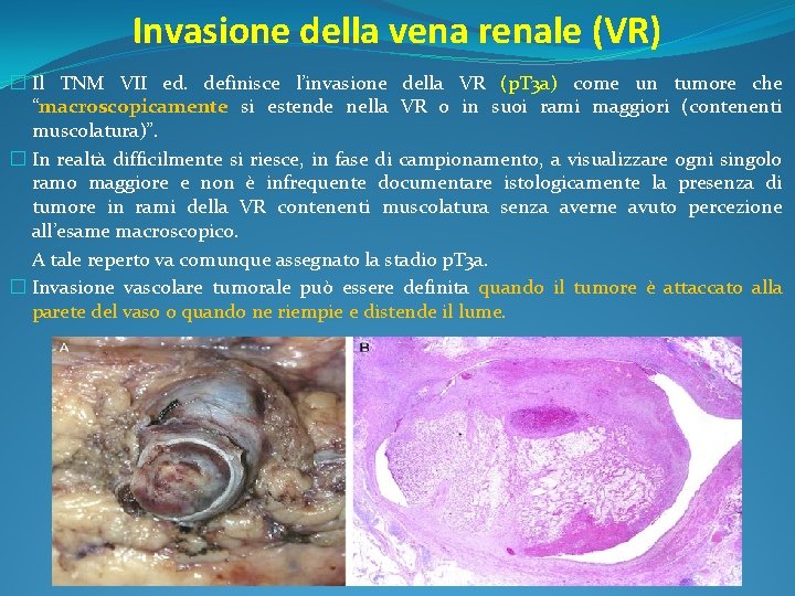 Invasione della vena renale (VR) � Il TNM VII ed. definisce l’invasione della VR