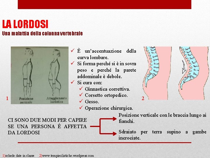 LA LORDOSI Una malattia della colonna vertebrale ü È un’accentuazione della curva lombare. ü