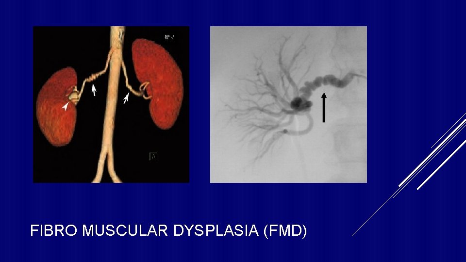 FIBRO MUSCULAR DYSPLASIA (FMD) FIBRO MUSCULAR DYSPLASIA (FMD)
