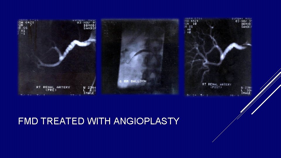 FMD TREATED WITH ANGIOPLASTY FMD TREATED WITH ANGIOPLASTY