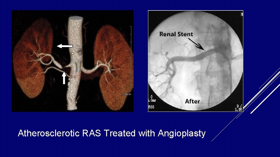 Atherosclerotic RAS Treated with Angioplasty Atherosclerotic RAS Treated with Angioplasty