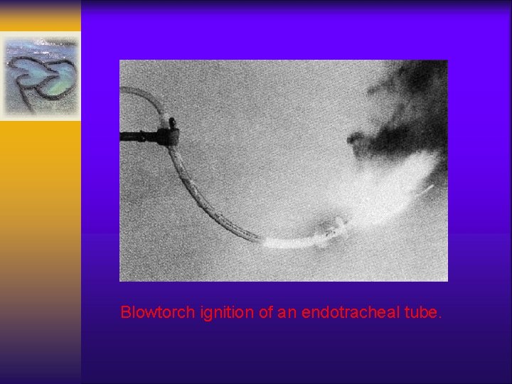Blowtorch ignition of an endotracheal tube. 