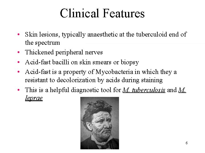 Clinical Features • Skin lesions, typically anaesthetic at the tuberculoid end of the spectrum