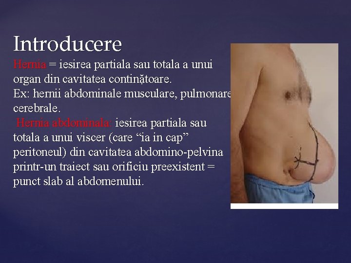 Introducere Hernia = iesirea partiala sau totala a unui organ din cavitatea continặtoare. Ex: