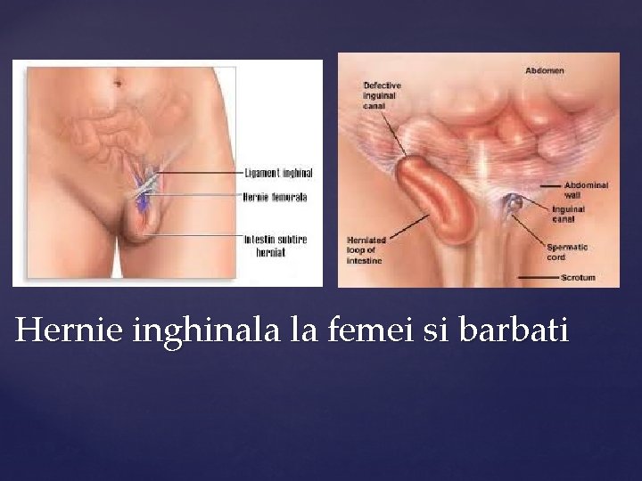 Hernie inghinala la femei si barbati 