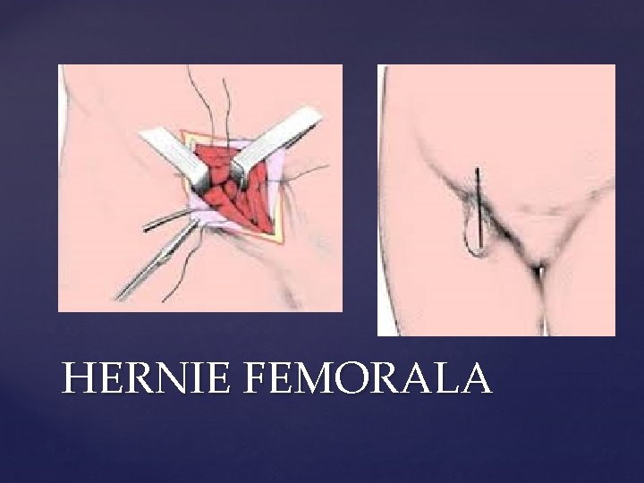 HERNIE FEMORALA 