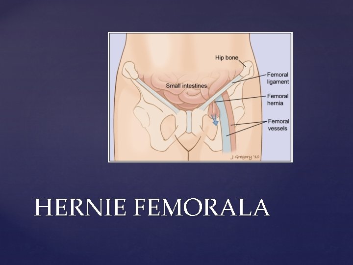 HERNIE FEMORALA 