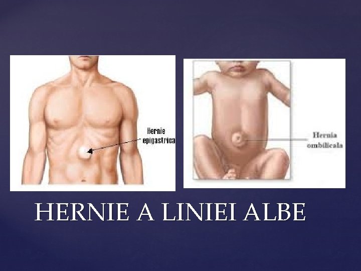 HERNIE A LINIEI ALBE 