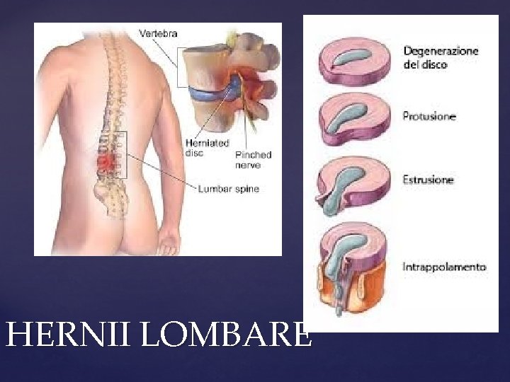 HERNII LOMBARE 