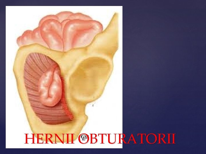 HERNII OBTURATORII 