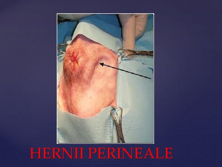 HERNII PERINEALE 