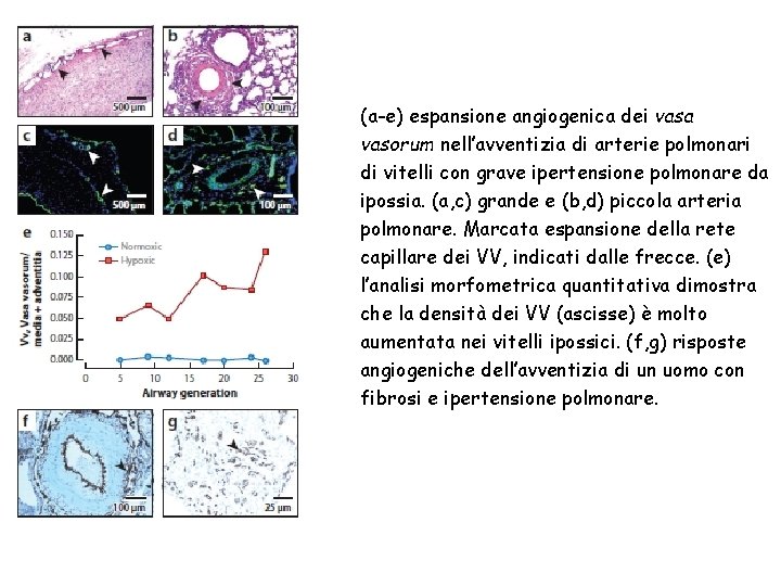 (a-e) espansione angiogenica dei vasa vasorum nell’avventizia di arterie polmonari di vitelli con grave