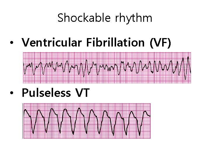 Shockable rhythm • Ventricular Fibrillation (VF) • Pulseless VT 