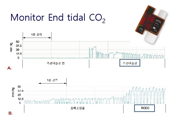 Monitor End tidal CO 2 