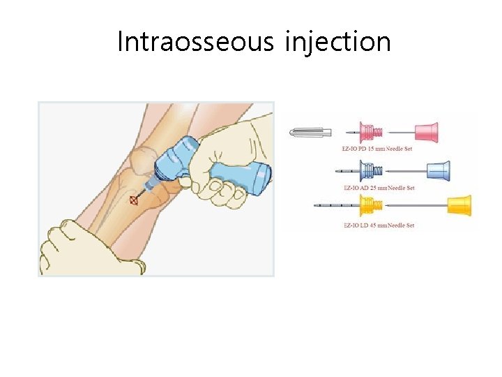 Intraosseous injection 