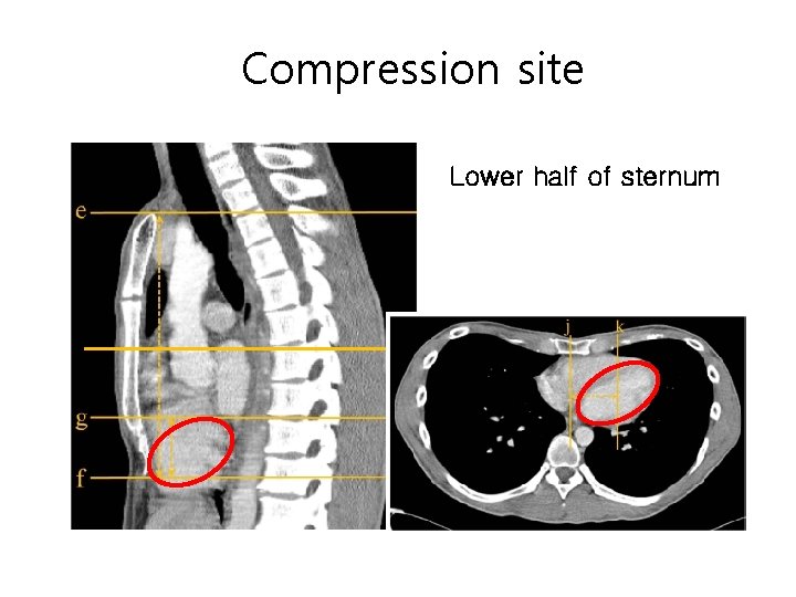 Compression site Lower half of sternum 