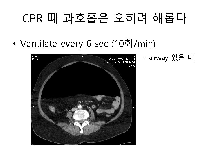 CPR 때 과호흡은 오히려 해롭다 • Ventilate every 6 sec (10회/min) - airway 있을