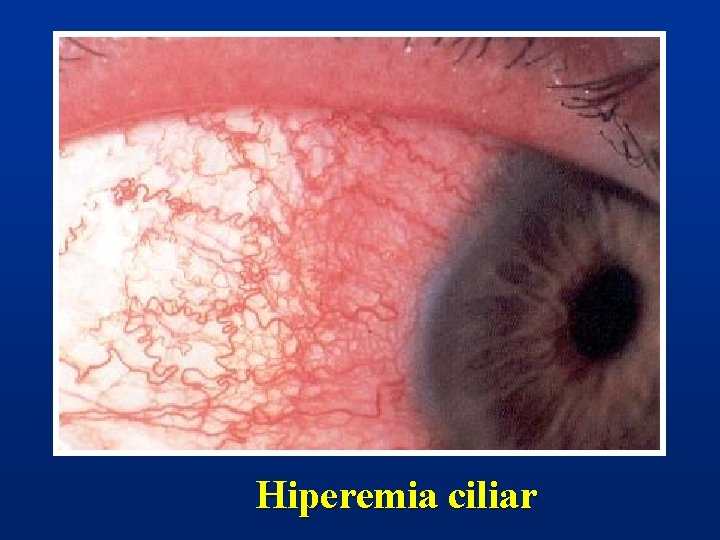 Hiperemia ciliar 